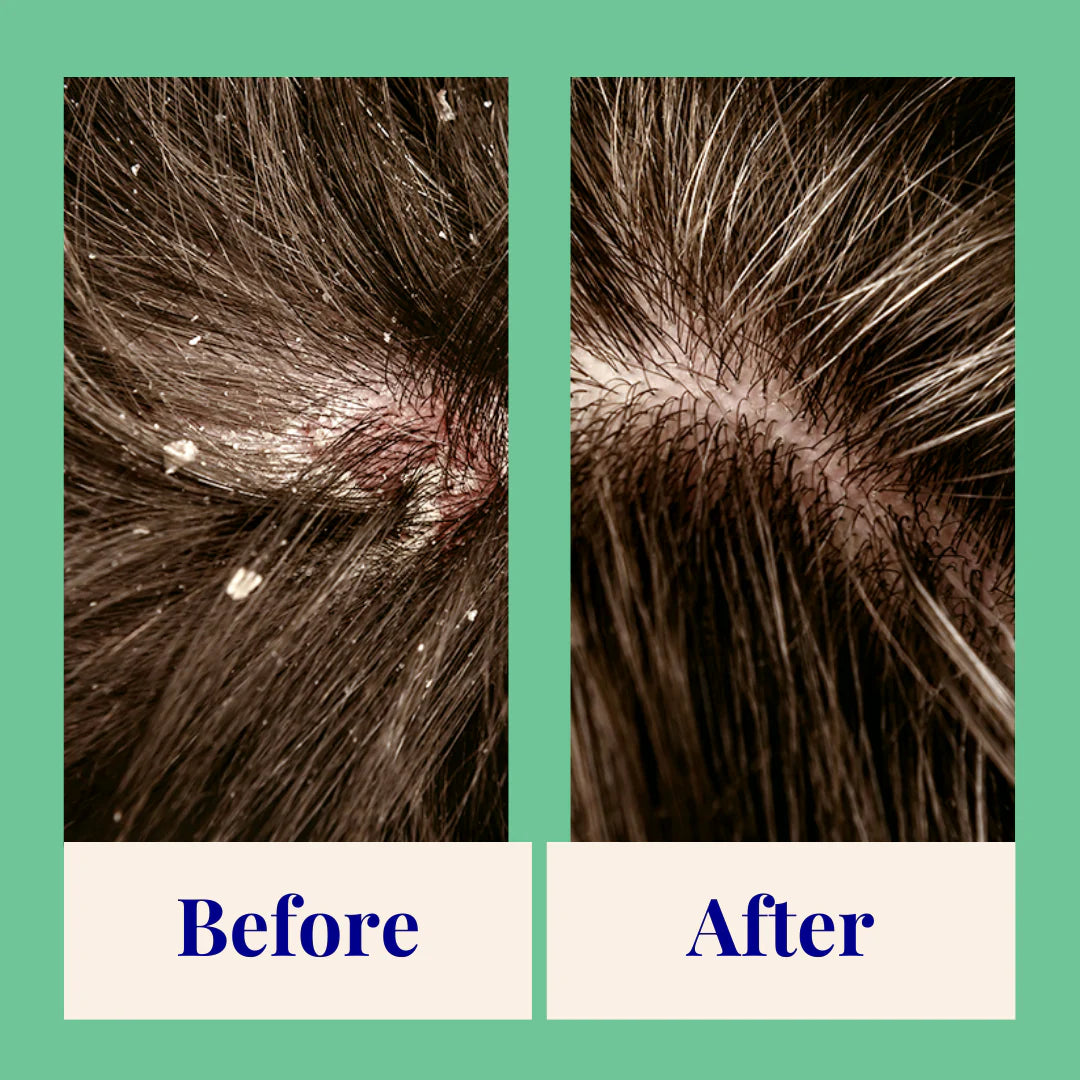 Exfoliating Shampoo For Loose Dandruff Flakes Tea Tree & Salicylic Acid